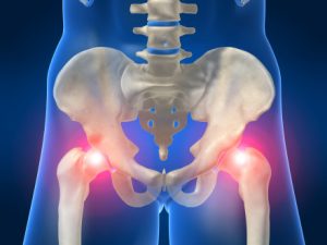 Hip Arthritis